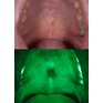 Bioscreen přístroj pro detekci rakoviny ústní dutiny 5